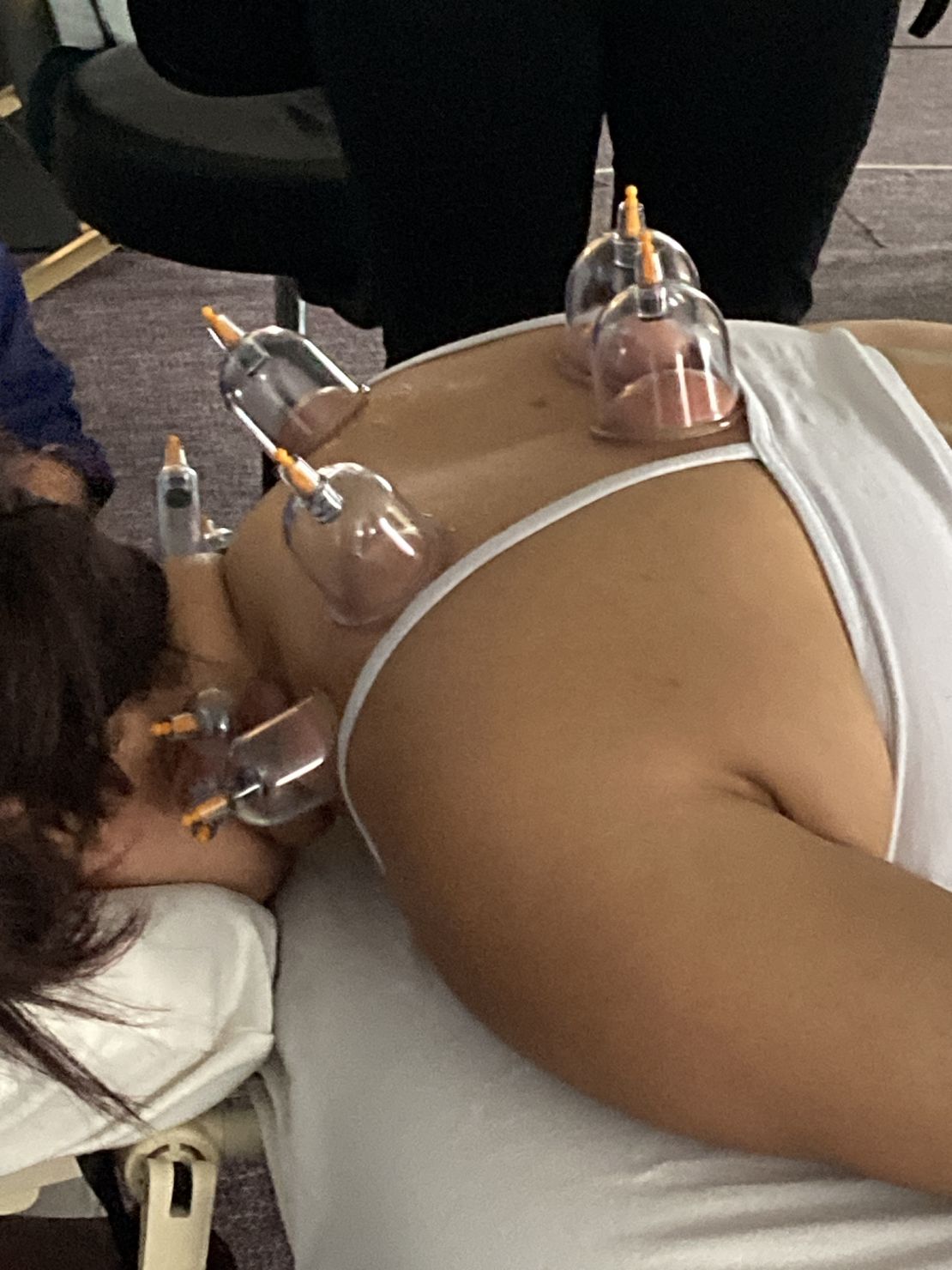 Cupping; Massage Therapy